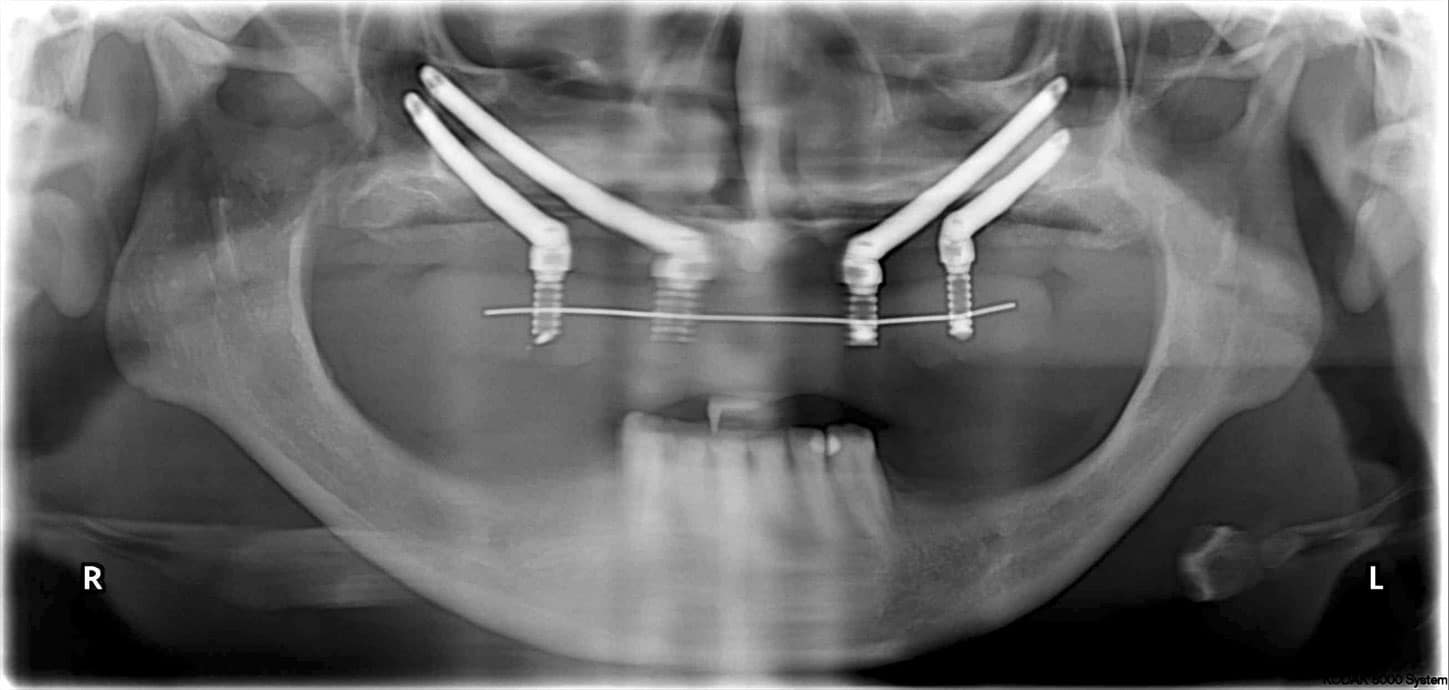 Ortopantomografia implantes cigomaticos