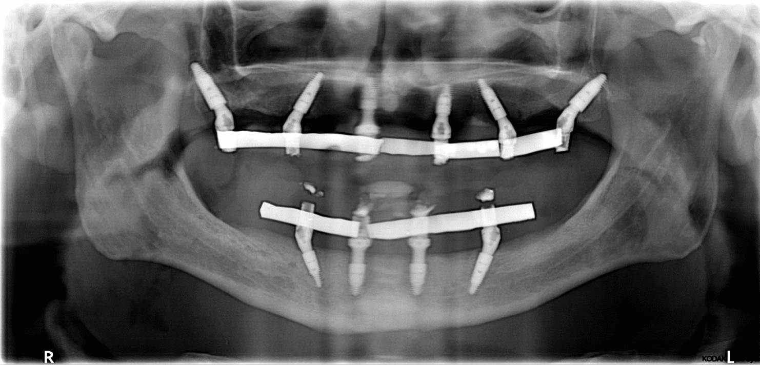 orto implantes dentales