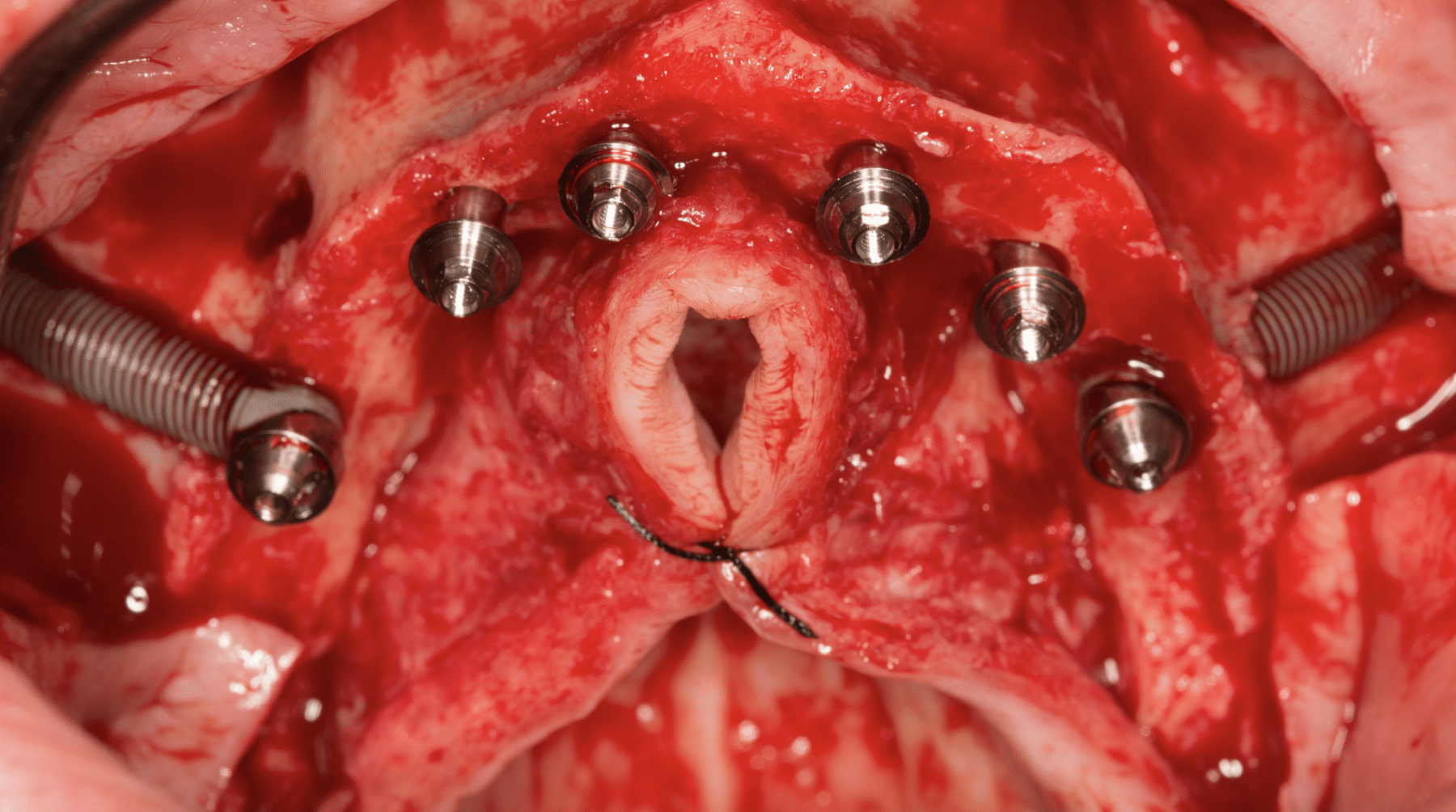 Implantes cigomaticos implantes convencionales en premaxila
