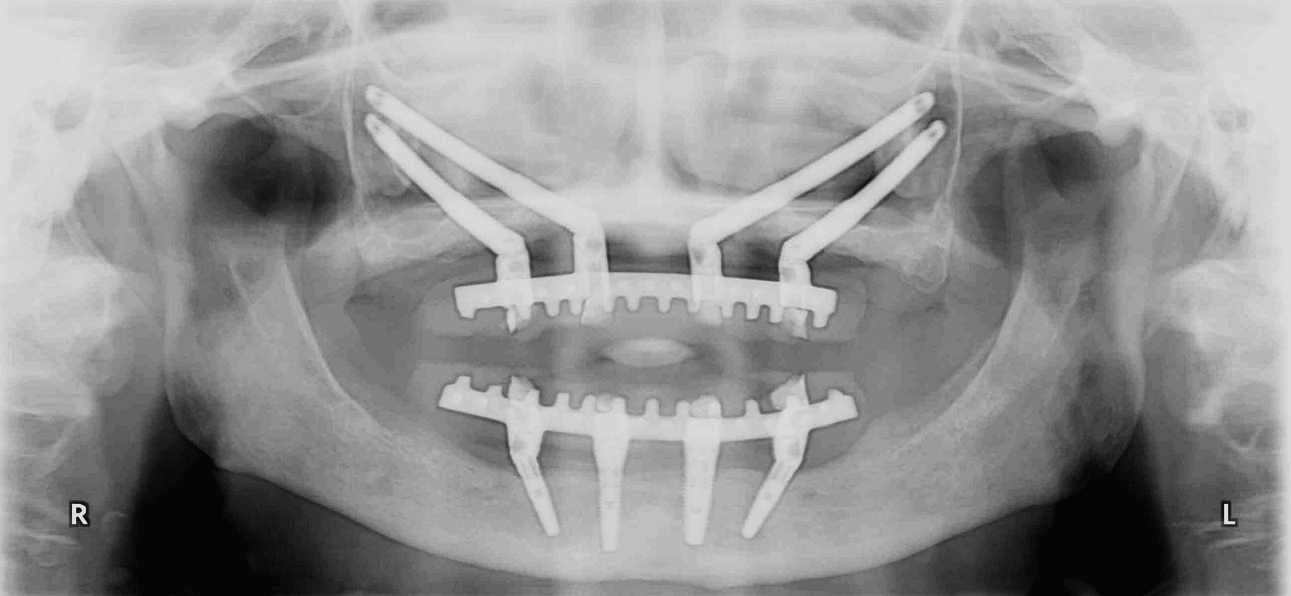 Ortopantomografia Zygoma Quad all-on-four maxilar inferior