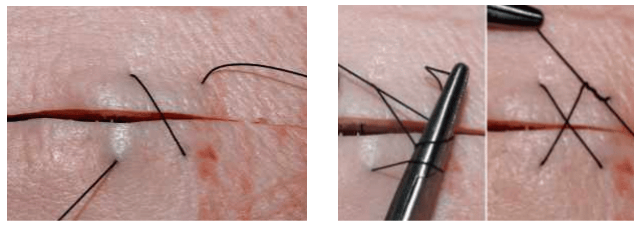 Tecnicas de sutura en piel