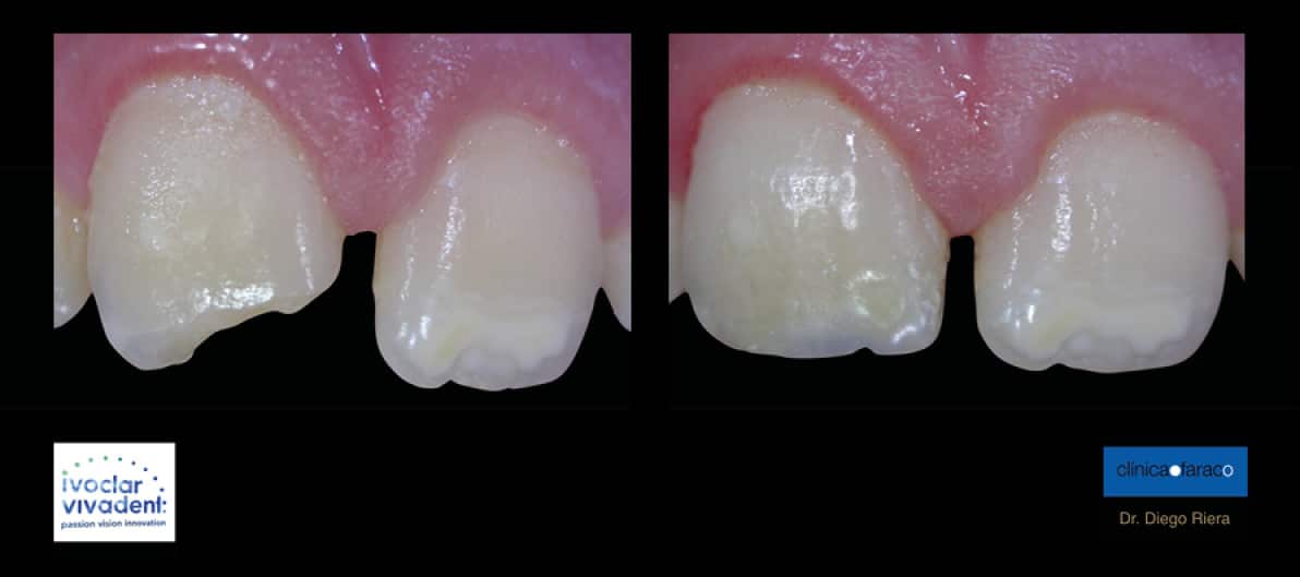 Adeshión a esmalte y dentina Vericat Formación