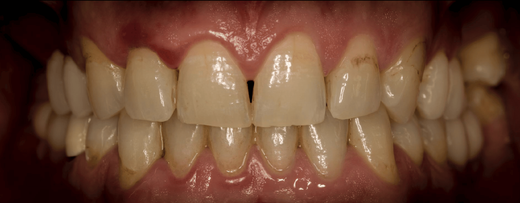 ausencias dentales sectores posteriores maxilar superior