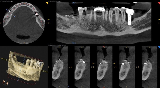 ortopantomografia altura mandibula posterior insuficiente