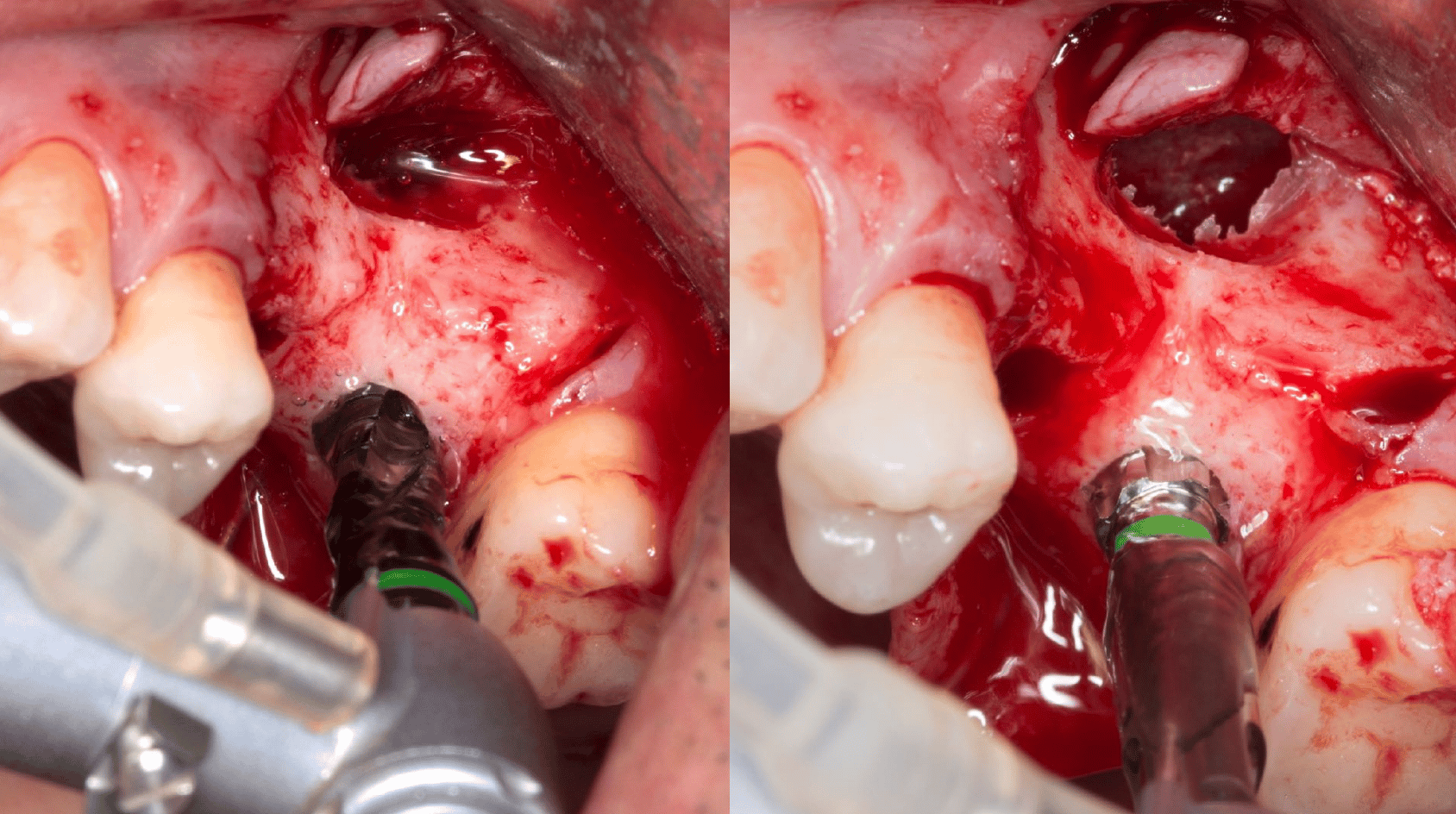 colocacion implante elevacion seno maxilar