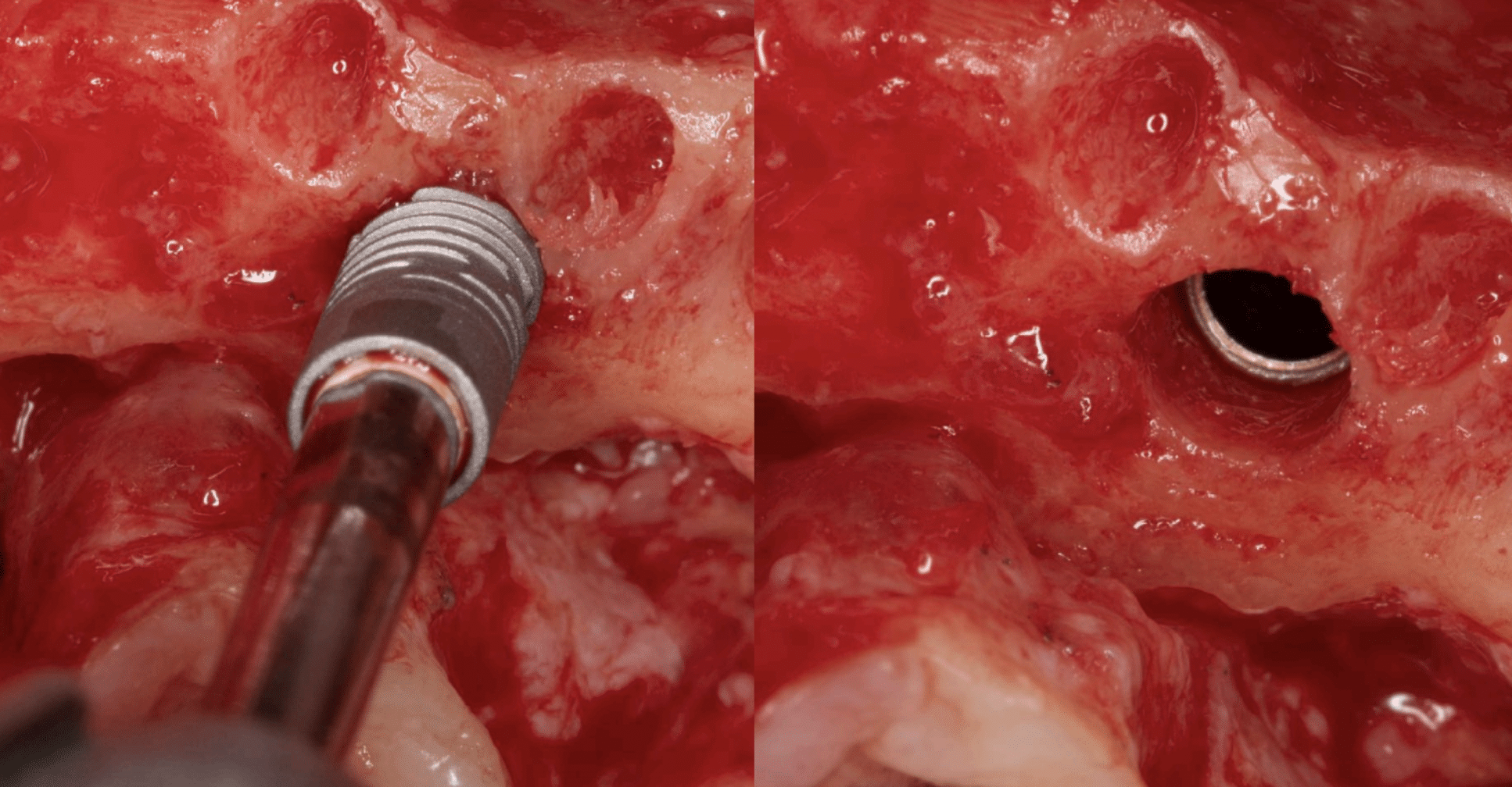 colocacion subcrestal implante