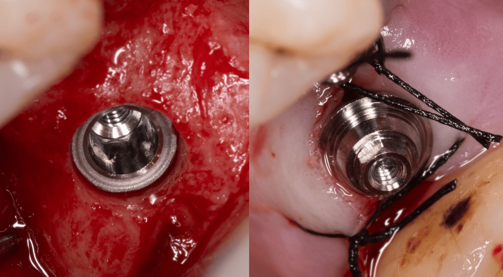 implante sutura