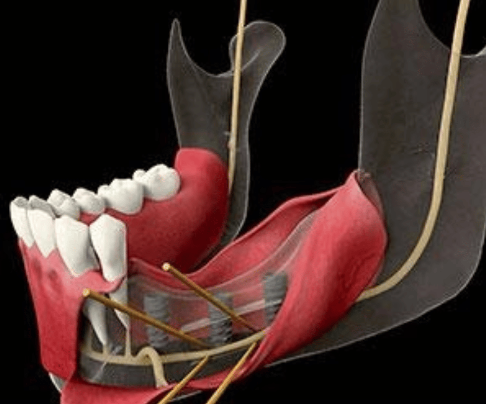 nervio dentario