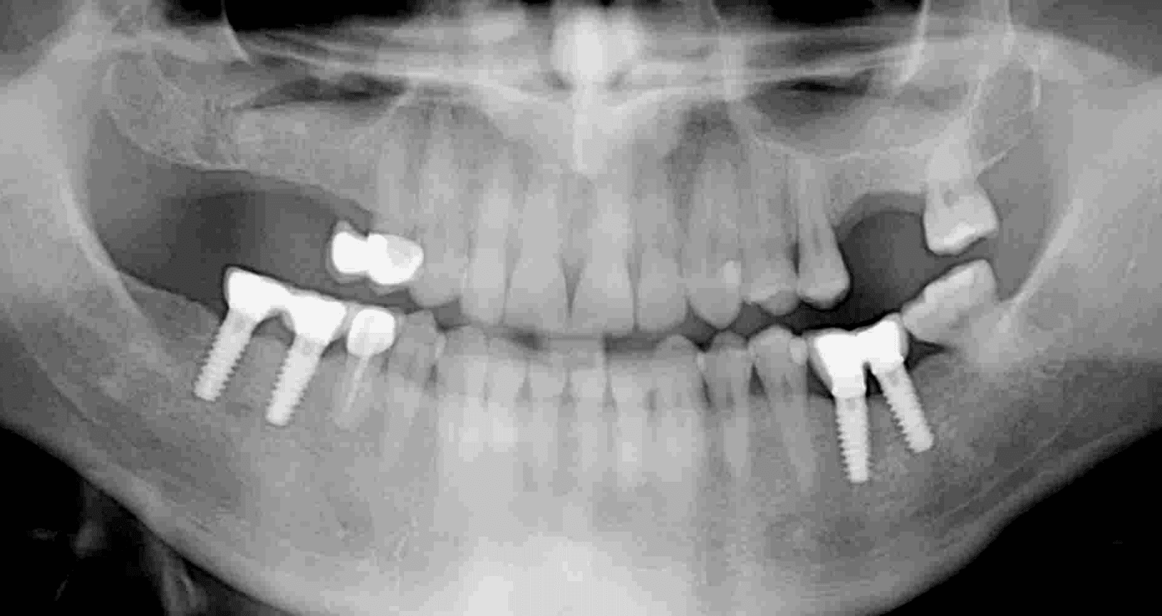 ortopantomografia ausencias maxilar superior