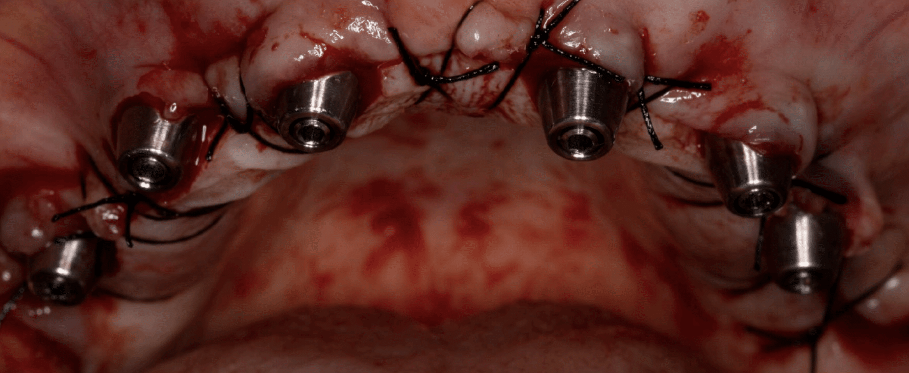 sutura maxilar superior